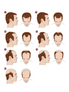 Die Abbildung zeigt die verschiedenen Ausprägungen der männlichen androgenetischen Alopezie nach dem Hamilton-Norwood-Schema.