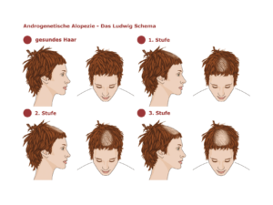 Die Abbildung zeigt die verschiedenen Ausprägungen der weiblichen androgenetischen Alopezie nach dem Ludwig-Schema.